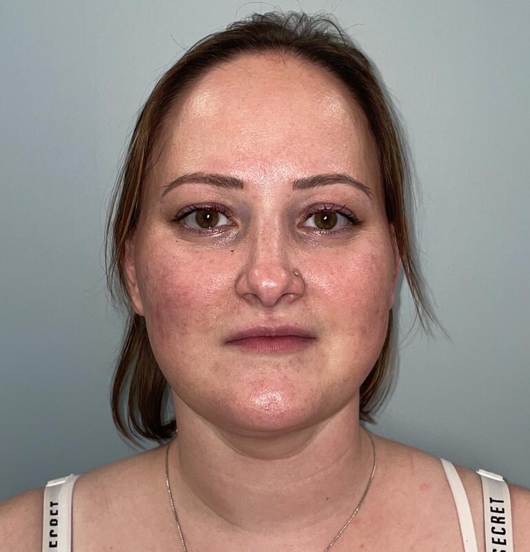 Neck Liposuction Before & After Image