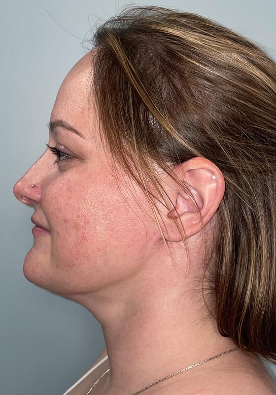 Neck Liposuction Before & After Image