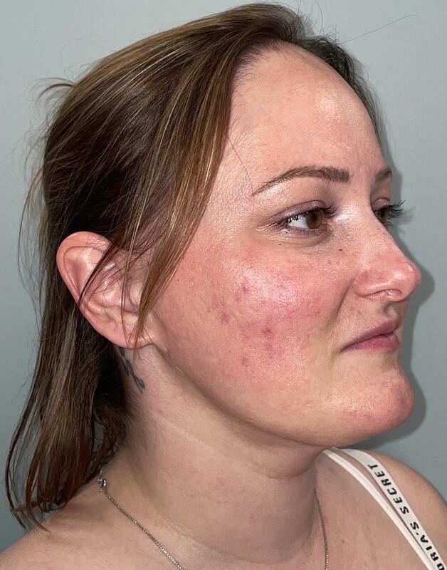 Neck Liposuction Before & After Image
