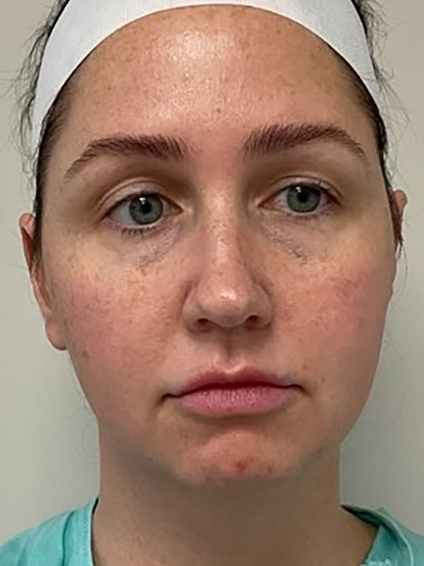 Neck Liposuction Before & After Image
