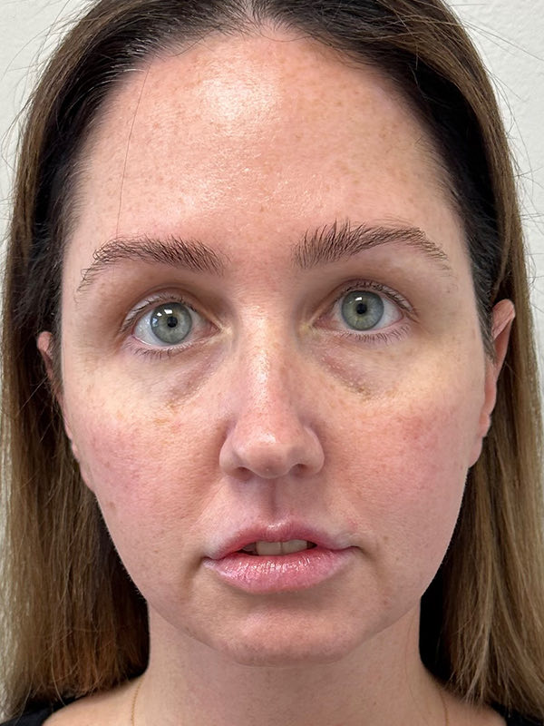 Neck Liposuction Before & After Image