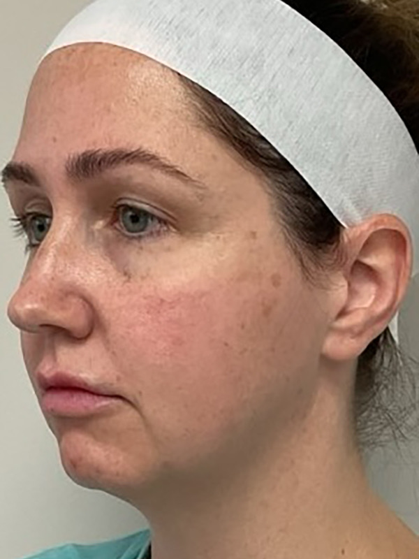 Neck Liposuction Before & After Image