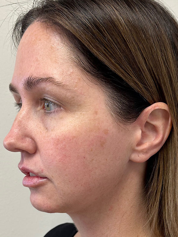 Neck Liposuction Before & After Image