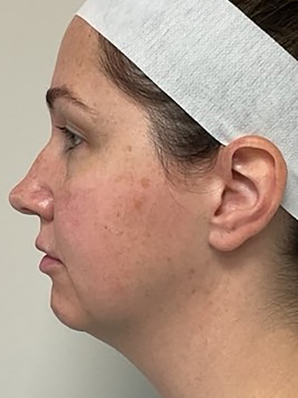Neck Liposuction Before & After Image