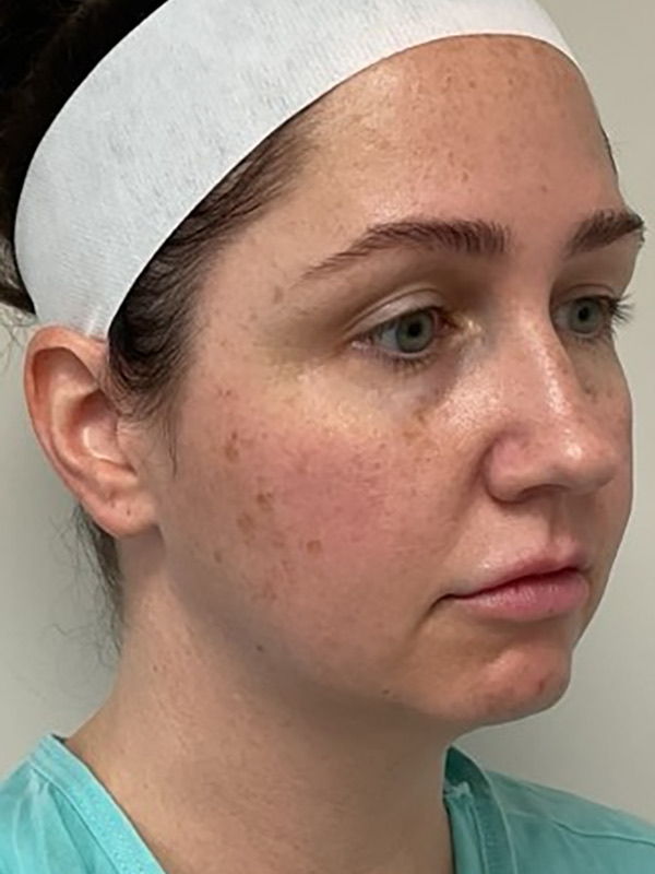 Neck Liposuction Before & After Image