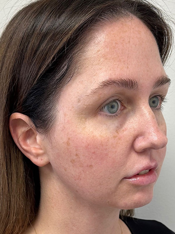 Neck Liposuction Before & After Image