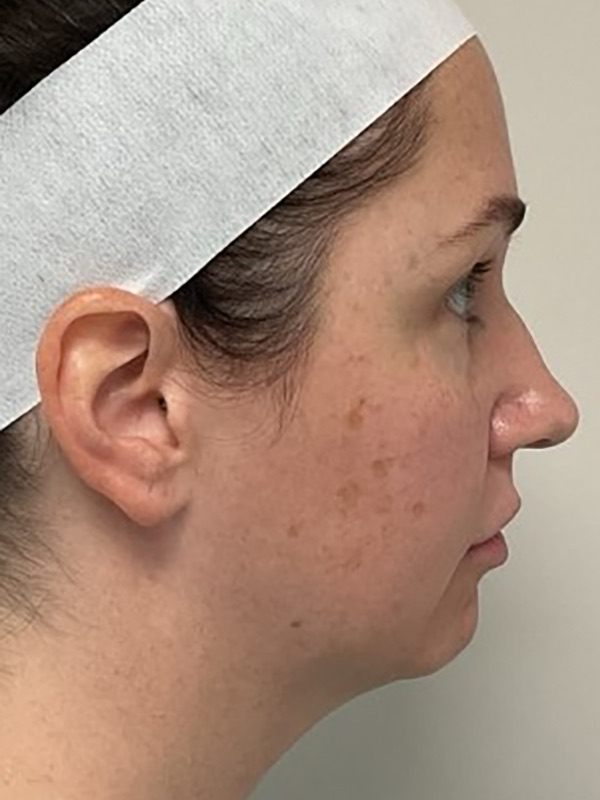 Neck Liposuction Before & After Image