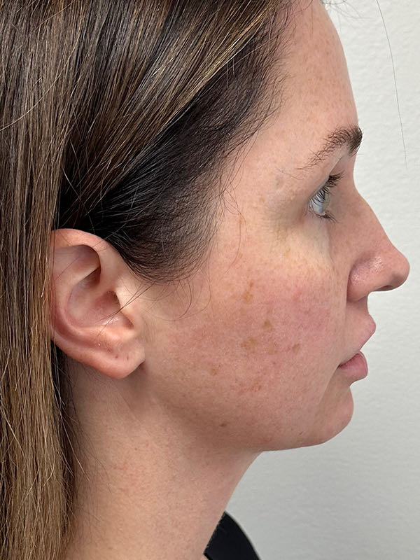 Neck Liposuction Before & After Image
